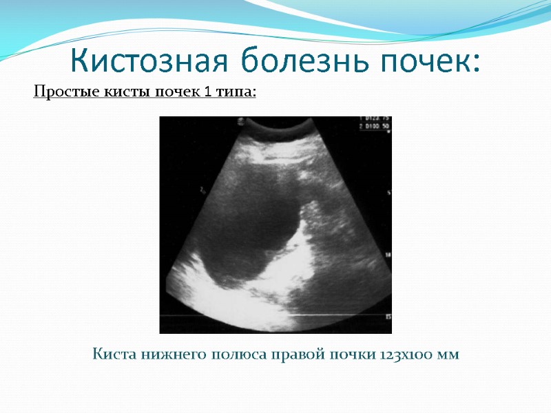 Кистозная болезнь почек: Простые кисты почек 1 типа:      